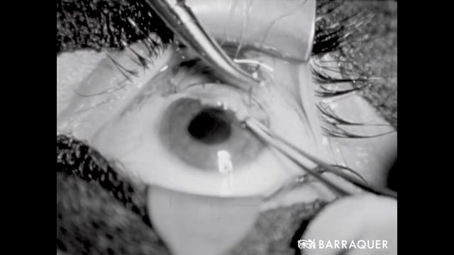 004 Cirugía de la catarata con inclusión de lente de Ridley-Prof. Joaquín Barraquer-1953 Barcelona