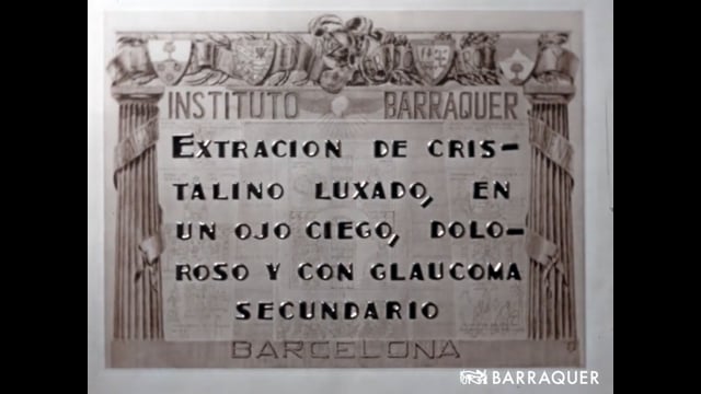 005 Extracción de cristalino subluxado en un ojo ciego, doloroso y con glaucoma secundario-Joaquín Barraquer-1955 Barcelona