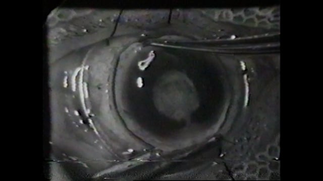 017 Extracción de catarata e iris por incisión total 1968 – Prof. Joaquín Barraquer Barcelona