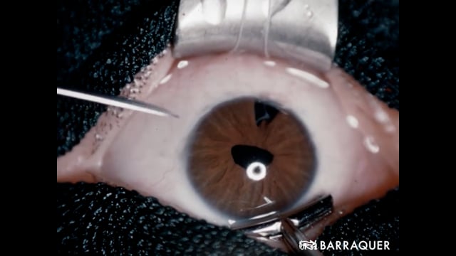 018 Implante de lente de Strampelli Varios casos – Prof. Joaquín Barraquer-1954 Barcelona