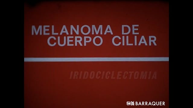 023 Melanoma de cuerpo ciliar, Iridociclectomía-1968-Prof. Joaquín Barraquer Barcelona