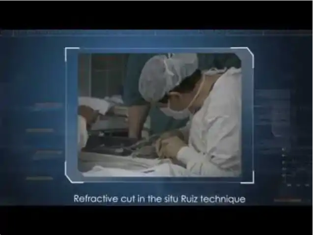 History and evolution of the refractive cut in lamellar surgery – L. Buratto