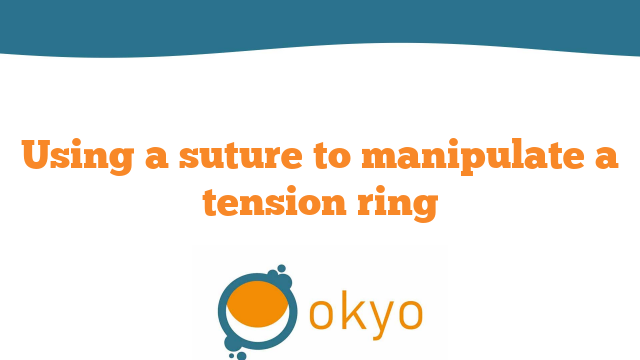 VJCRS – Using a suture to manipulate a tension ring